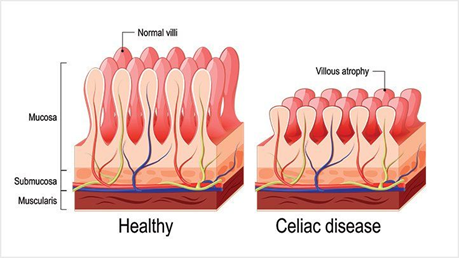 Pictured above is an example of the villi in the small intestine, they absorb and spread the nutrients you ate throughout the body. Compared to someone with Celiac Disease, they are cut shorter which means the person gets little to no nutrients.